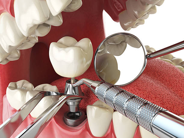 Best Broken or Cracked Tooth Emergency Dentist in Dublin, VA